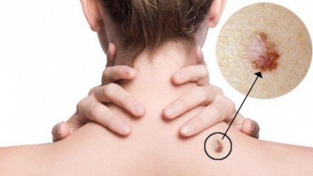 Billedresultat for Simptomat e kancerit