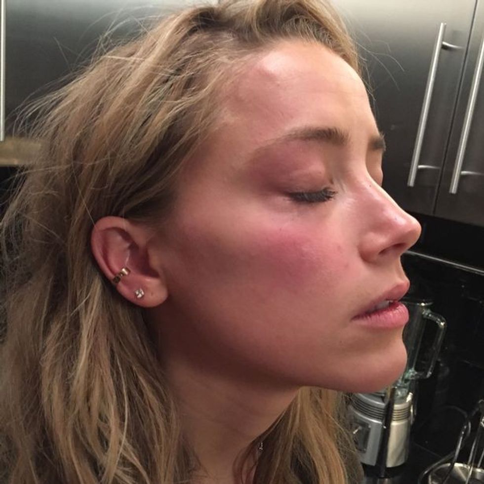 0 Amber Heards reddened face after Johnny Depp hurled a phone at her during row