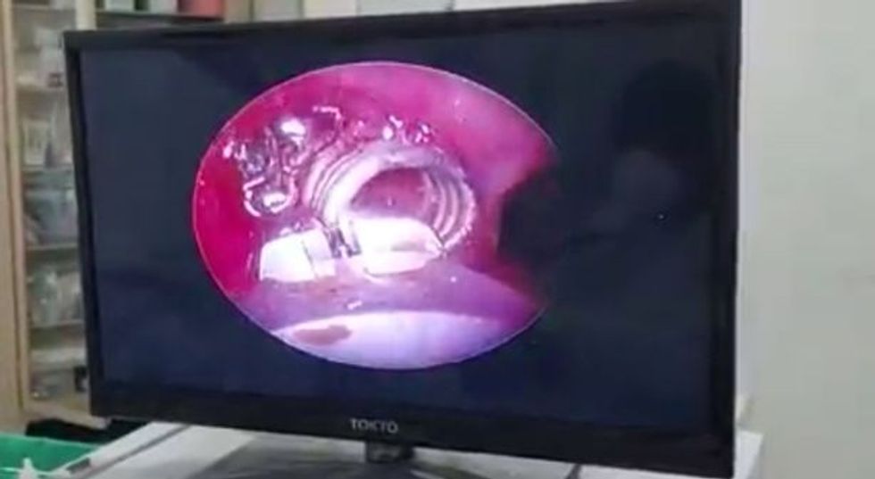 0 PAY Boy five had metal spring in his lung for THREE MONTHS 1