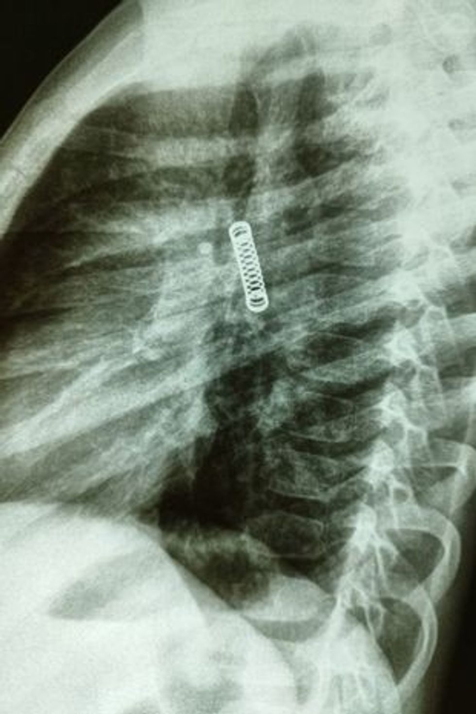 0 PAY Boy five had metal spring in his lung for THREE MONTHS