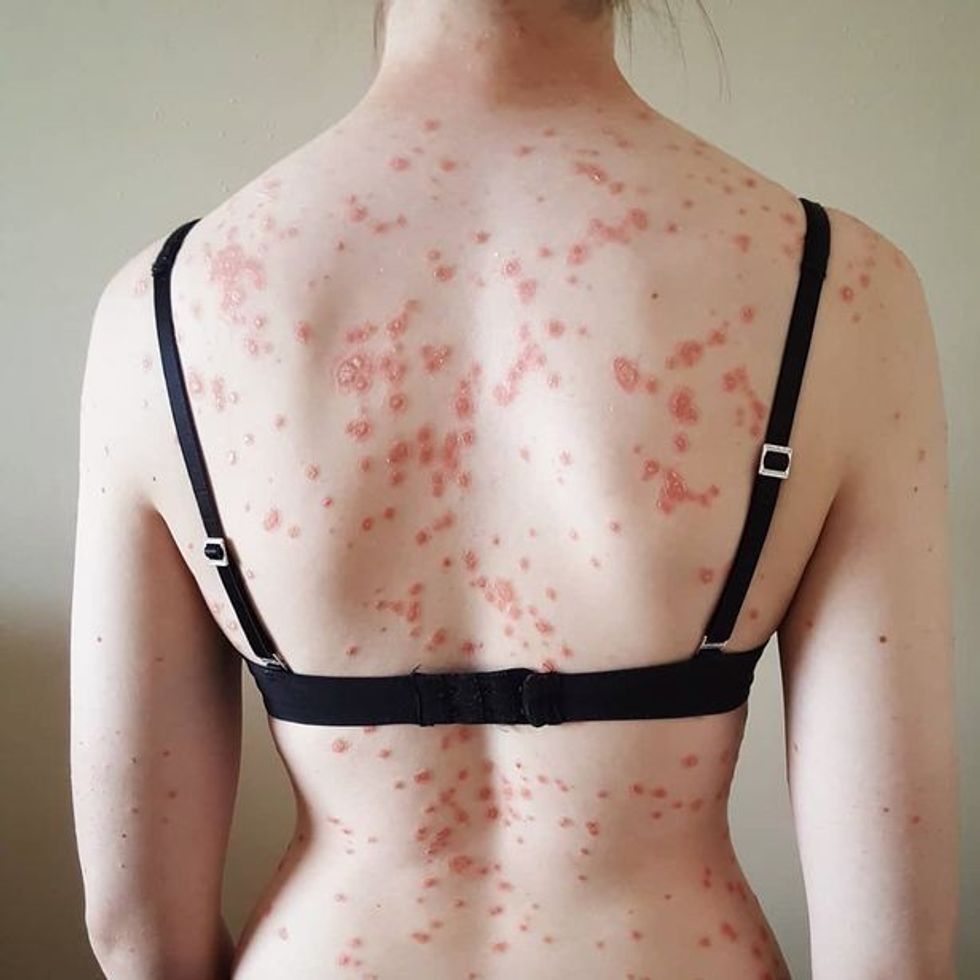 0 PAY UK Psoriasis Spotty Body