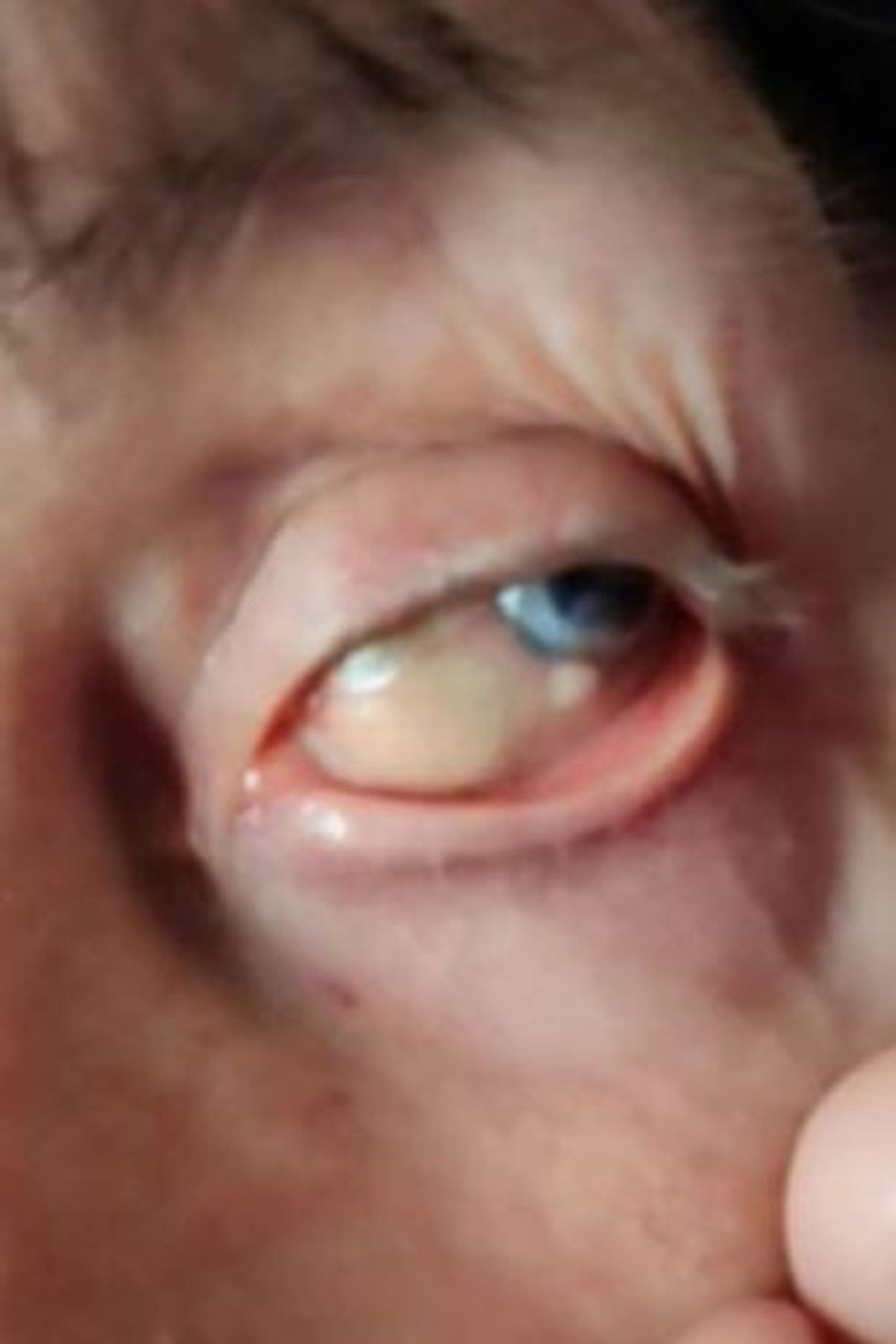 0 PAY Woman lives with stone in eye for 54 years after being fobbed off by 20 doctors