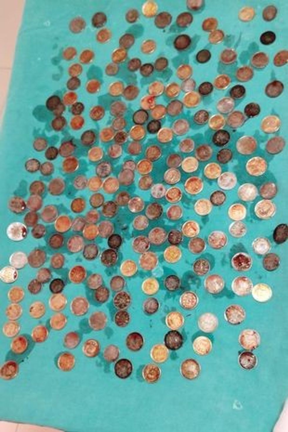 0 SWNS STOMACH COINS 02 1