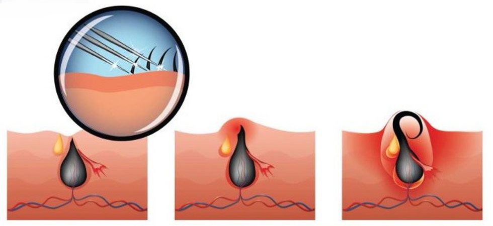 01 acne How to Treat Acne in Your