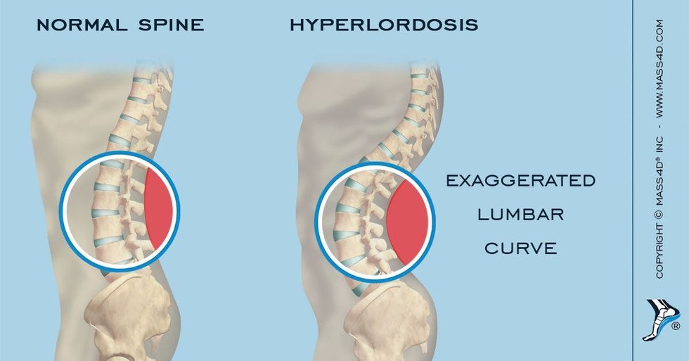05 31 2017 Lumbar Hyper Lordosis