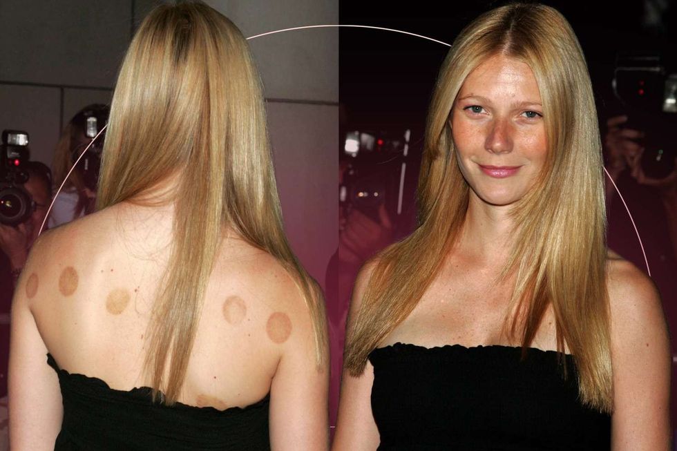 080222 Cupping Therapy Lead 2000 d7edef8c8c4c4cc98c6e6852f619e3c9