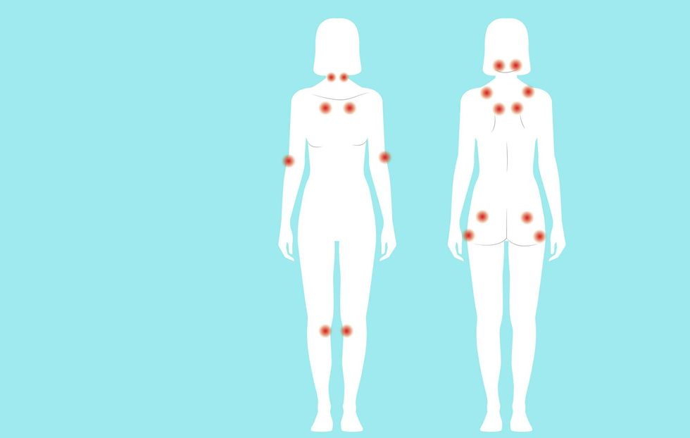 0819 Fibromyalgia Tender Points