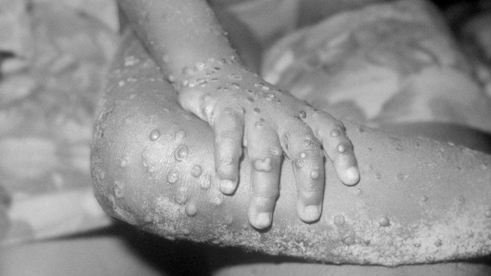 103585163 monkeypox getty