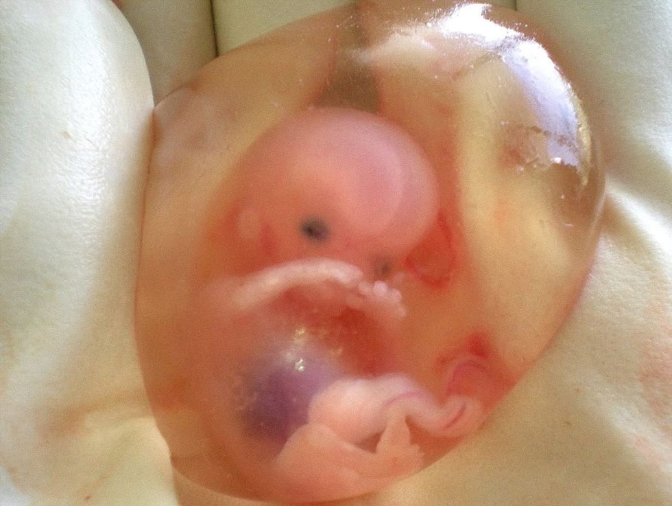1200px Human fetus 10 weeks with amniotic sac