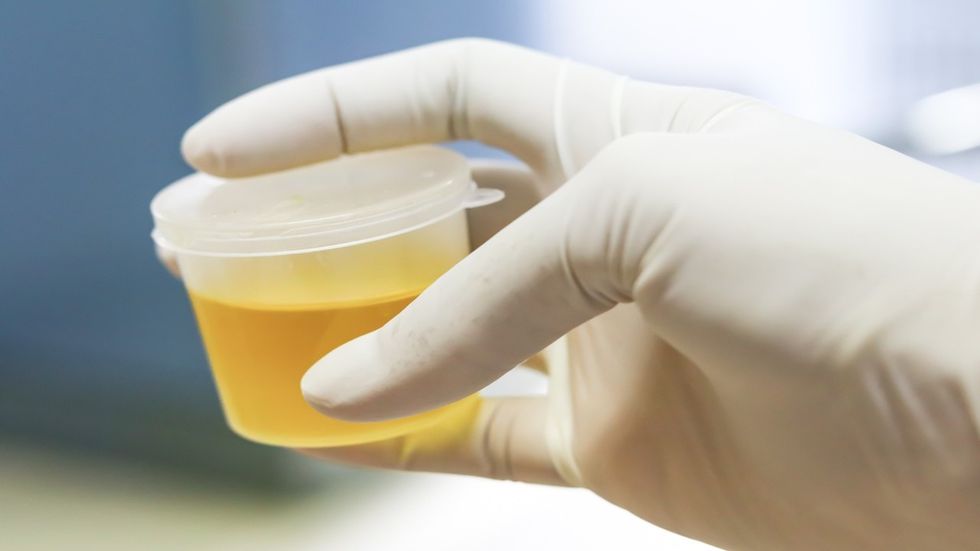 1280 636187634 cloudy urine sample