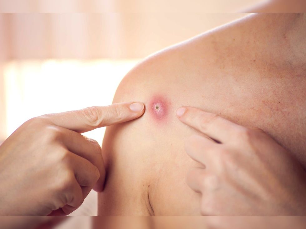 1626521746 monkeypox 1