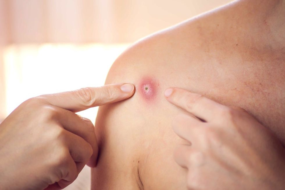 1626521746 monkeypox