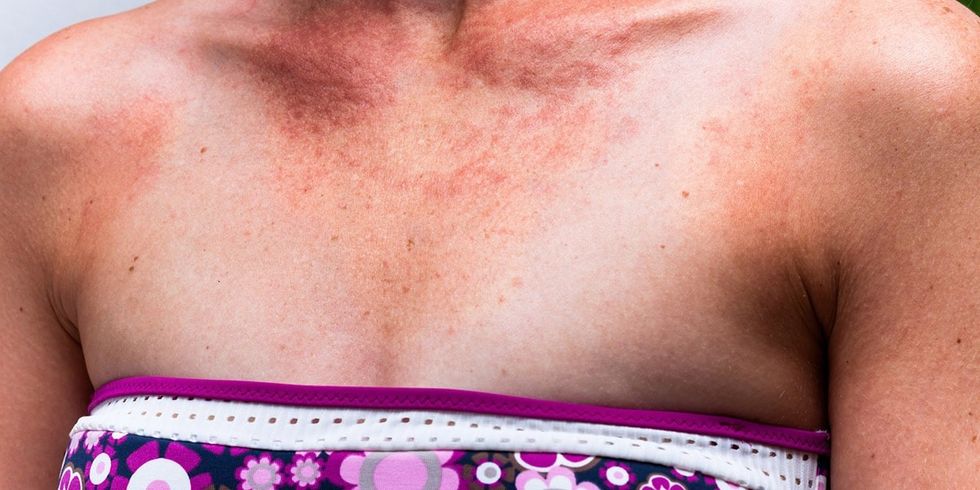 20160704 Sun Allergy