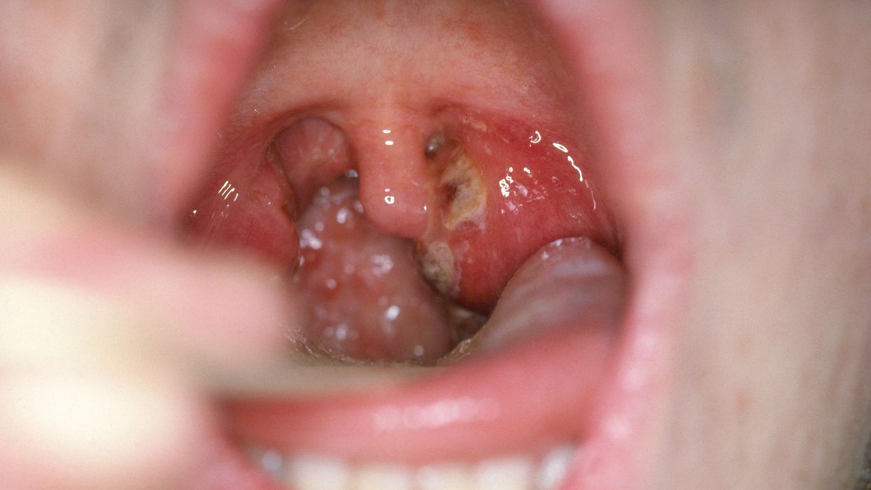 2017/09/c0144371-strep-pharyngitis-science-photo-library-high-scaled.jpg