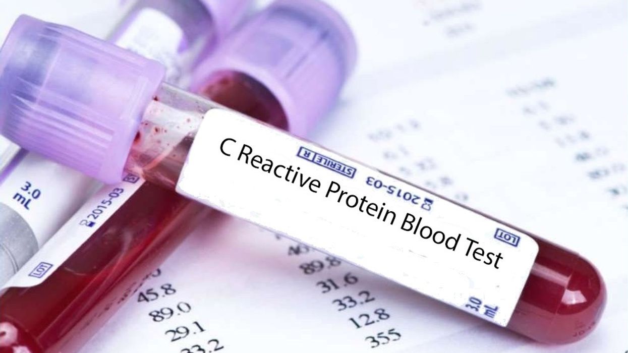2018/05/c-reactive-protein-blood-test.jpg