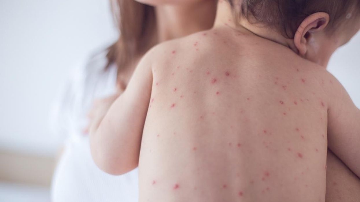 2019/08/measles-spot.jpg