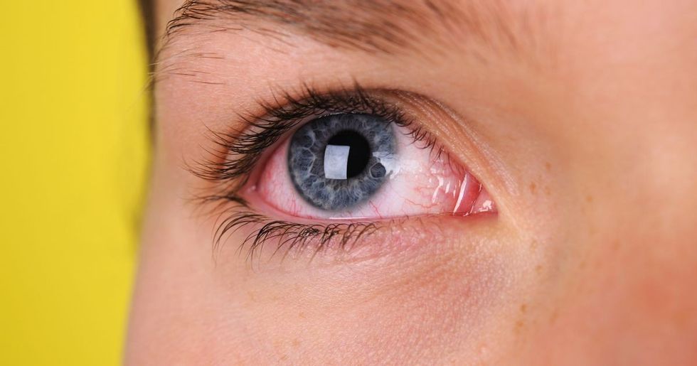2020/08/coronavirus-conjunctivitis.jpg