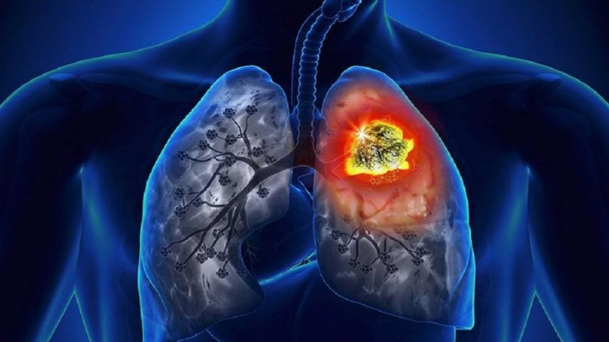 2020/09/lung_cancer_571_855.jpg