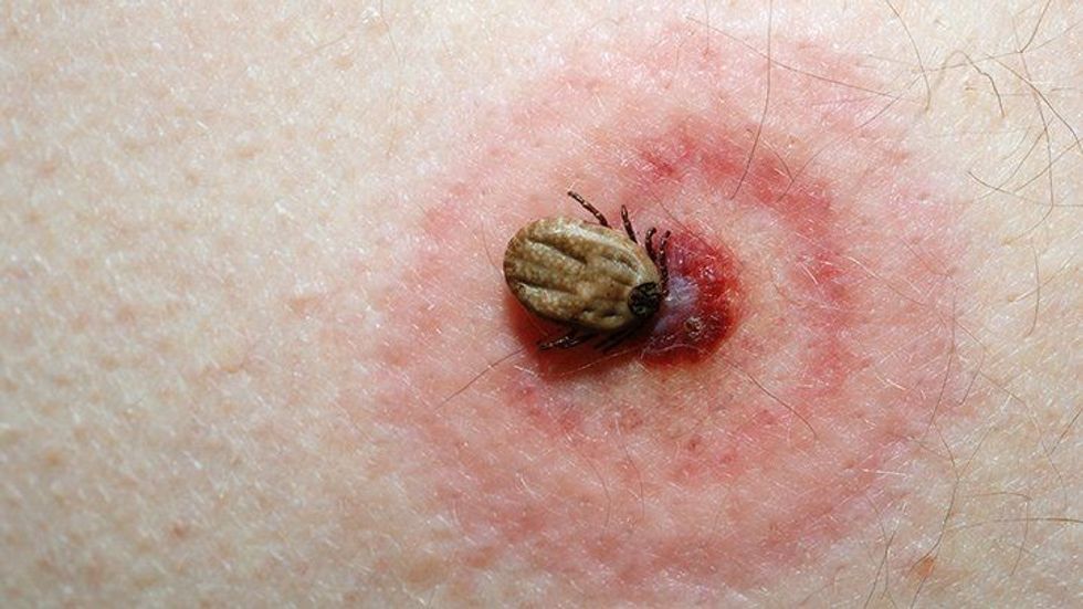 2021/06/bug-bite-guide-tick-bites-722x406-1.jpg