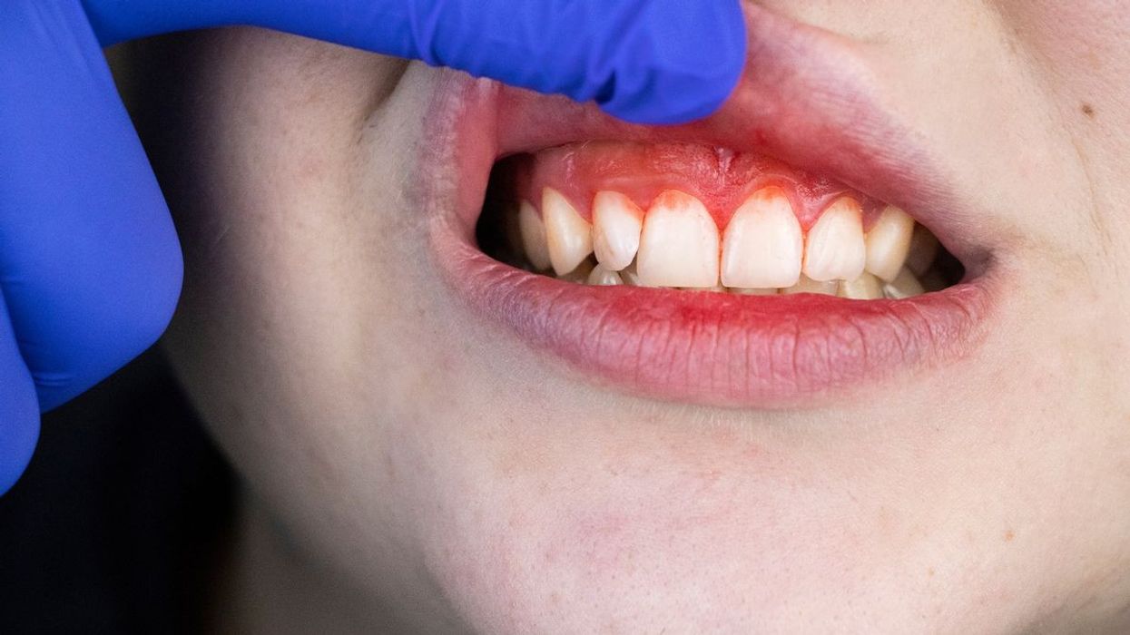 2021/12/0_Gum-bleeding-and-inflammation-close-up-A-man-examined-by-a-dentist-The-diagnosis-of-gingivitis.jpg