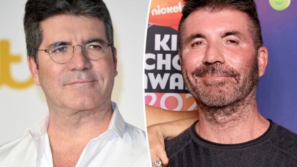 2022/04/1649795937_simon-cowell-botox-new-768x511-1-e1649796063850.jpg