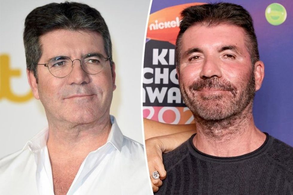2022/04/1649795937_simon-cowell-botox-new-768x511-1-e1649796063850.jpg