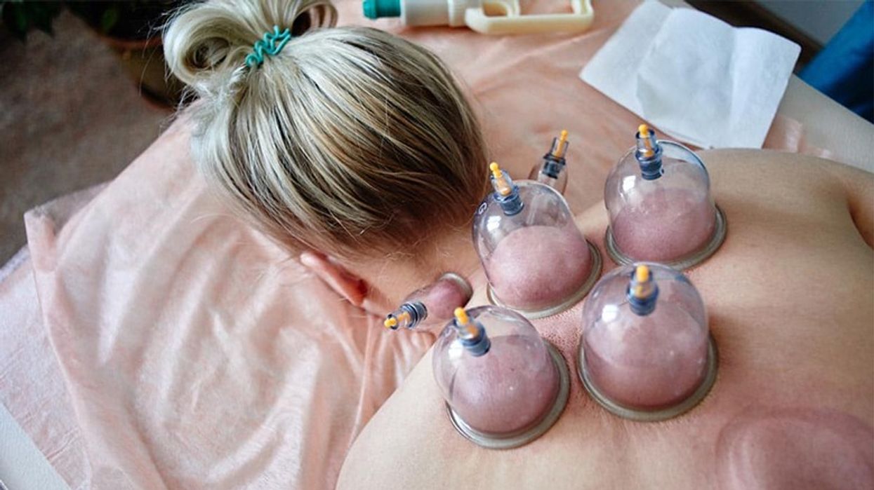 2022/05/Amazing-Benefits-of-Hijama.jpg