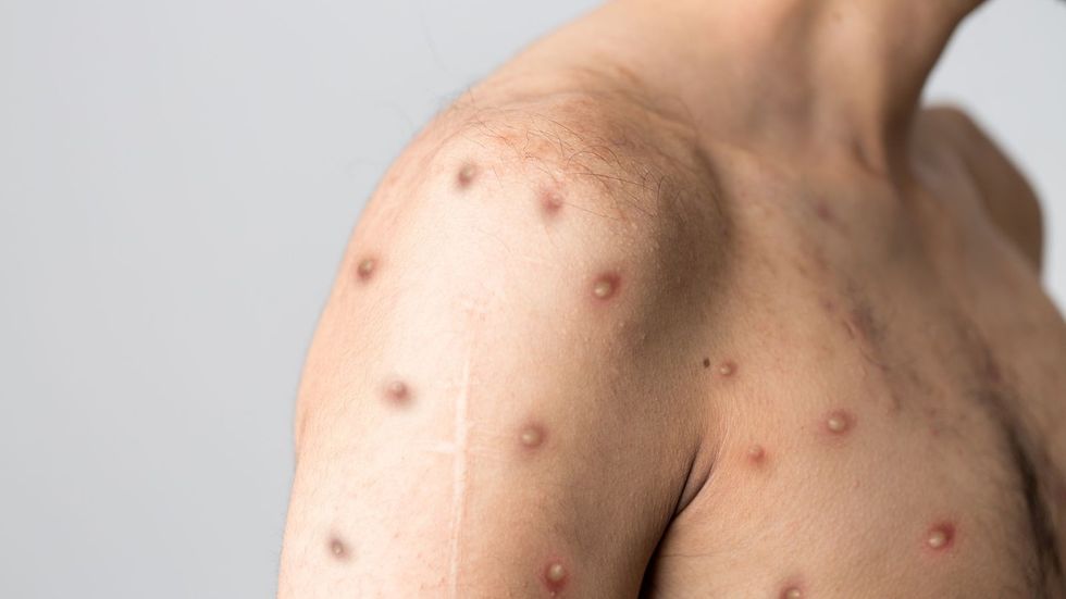 2022/07/skynews-monkeypox-disease_5831864.jpg