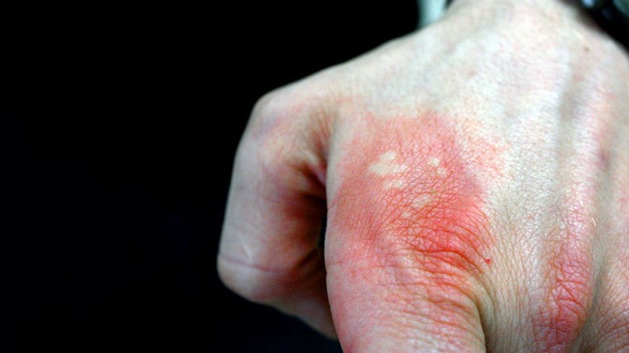 2022/09/Nettle_sting_5590837651_thumb-732x549-1.jpg