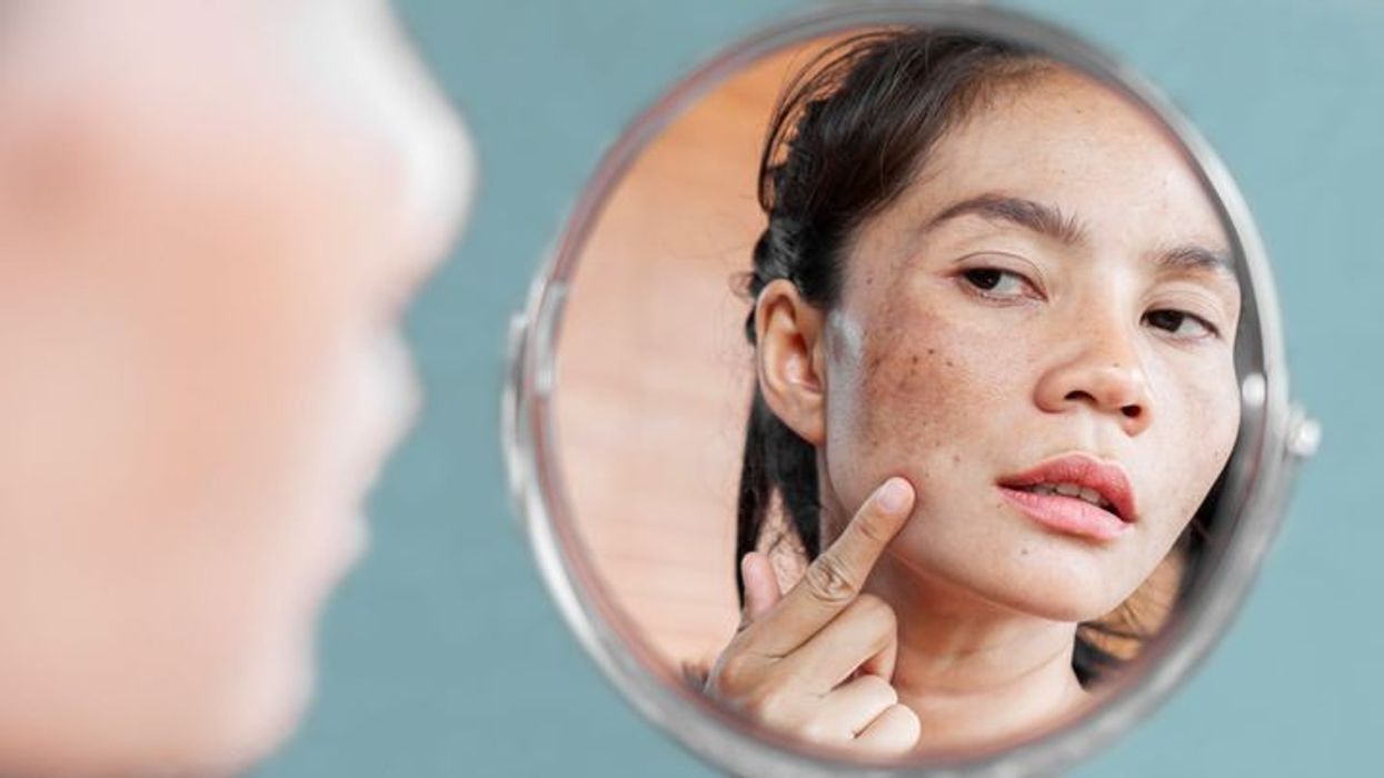 2023/03/ways-to-get-rid-of-hyperpigmentation-for-good-hands-off-alt-1440x810-1.jpg