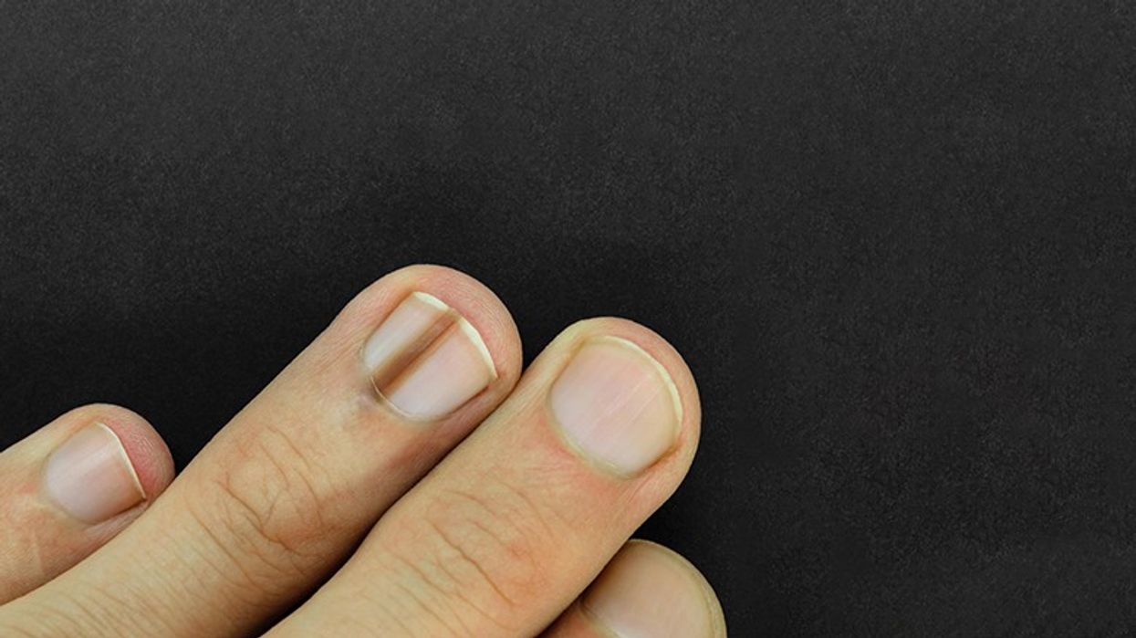 Silent symptoms of cancer that appear in the nails: If you notice these changes, go to the doctor immediately - Telegraph