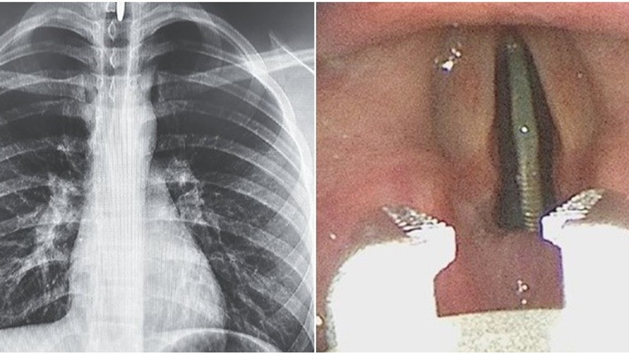 2024/04/Teen-Has-Metal-Coin-Stuck-Between-Vochal-Cords-in-Bizarre-Accident.jpg