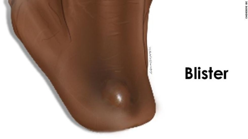 220110170941 restricted chidiebere medical illustration 2 exlarge 169