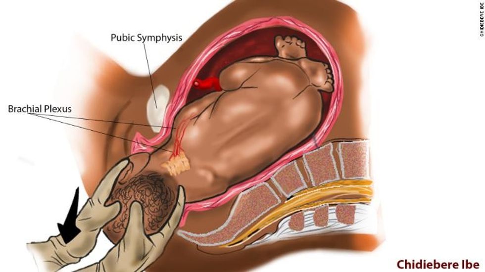 220113084818 restricted chidiebere medical illustration 10 2 exlarge 169