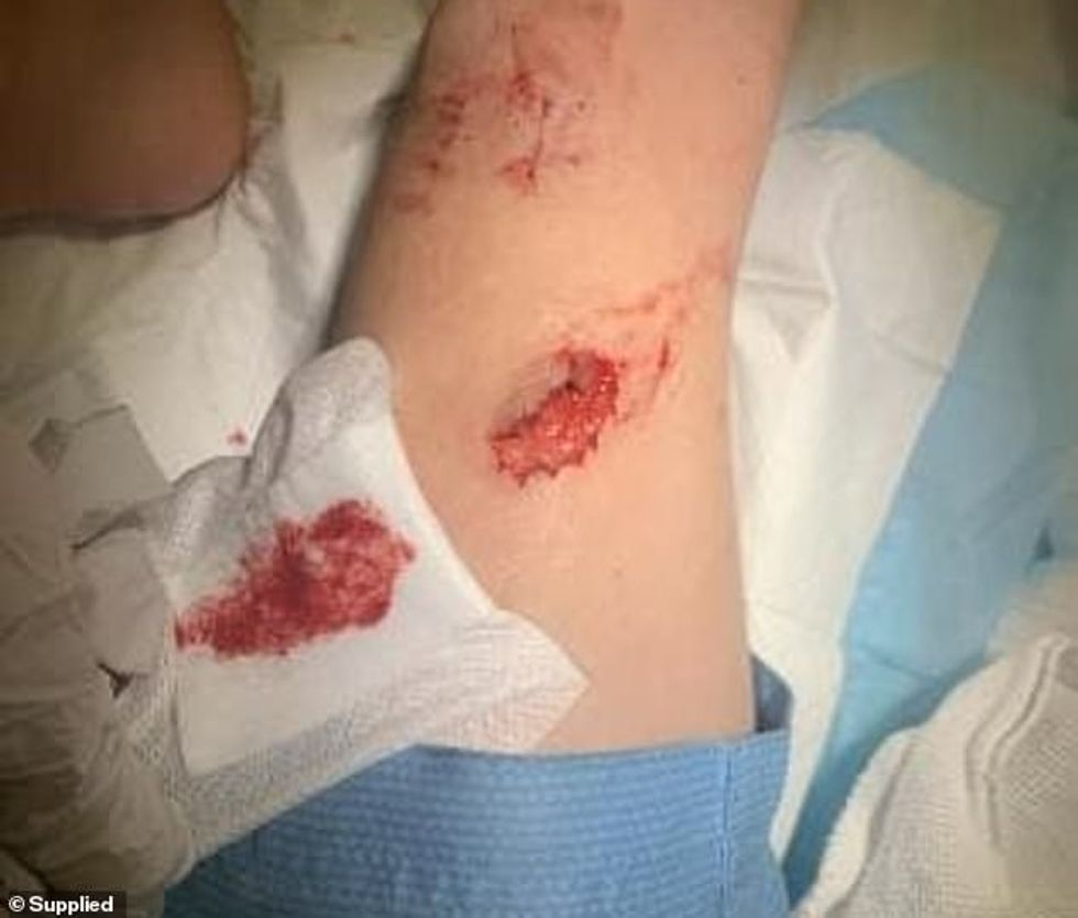 22492280 7819939 The injuries the young boy sustained from the snake attack in Ai a 3 1577058836838