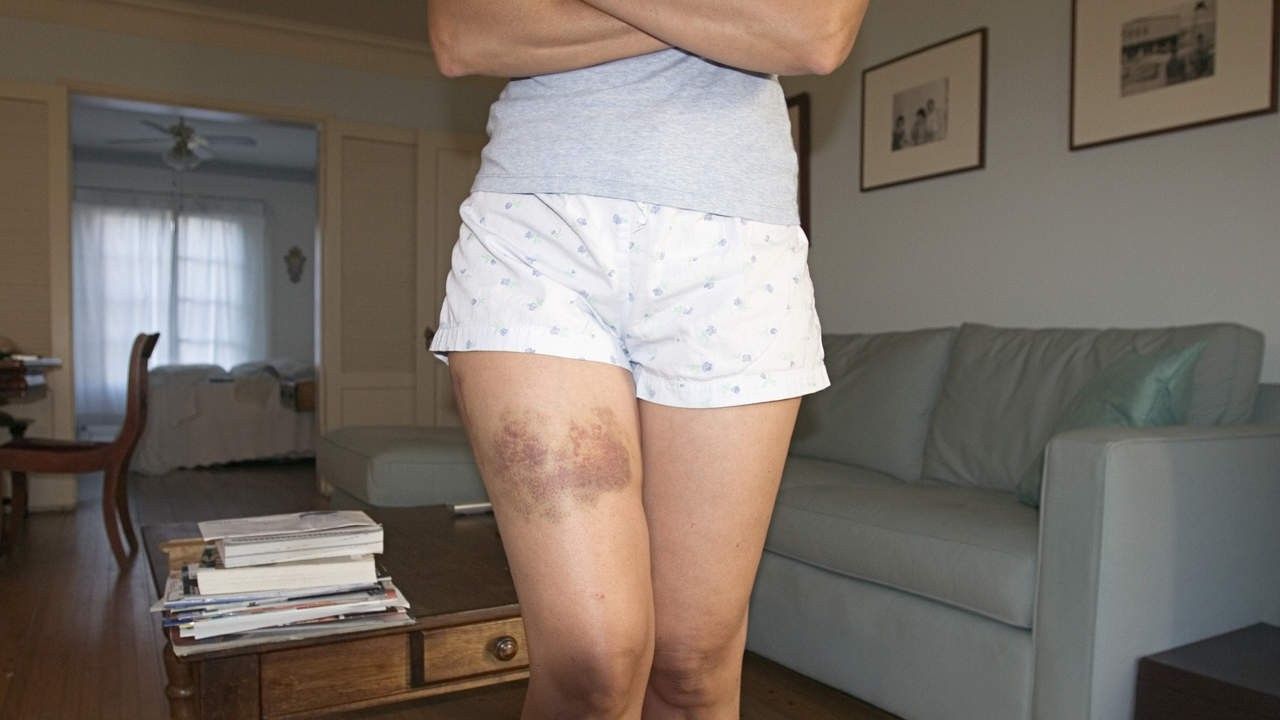 2018/07/bruising-easily-gettyImages-88403404.jpg
