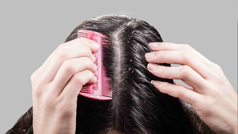 2024/04/woman-removes-dandruff-from-black-hair-comb-scaled-1.jpg