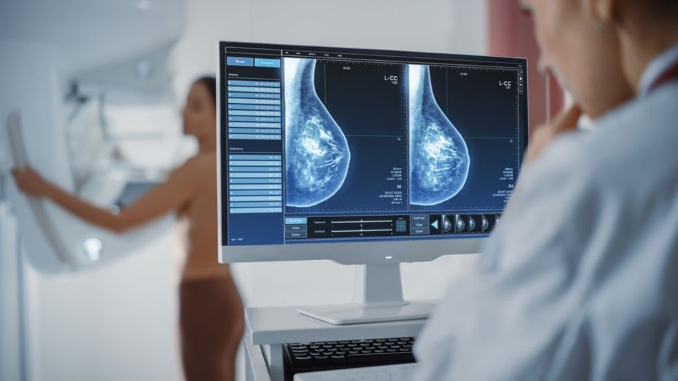 3D MAMMOGRAM 1