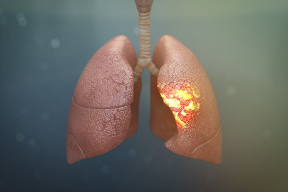 3d medical animations pneumonia