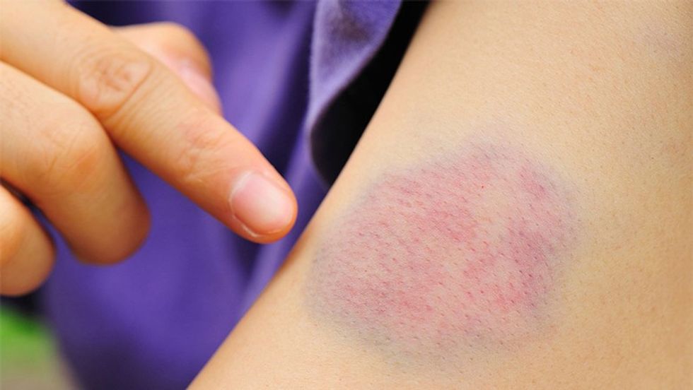 4 bruising silent leukemia lzf