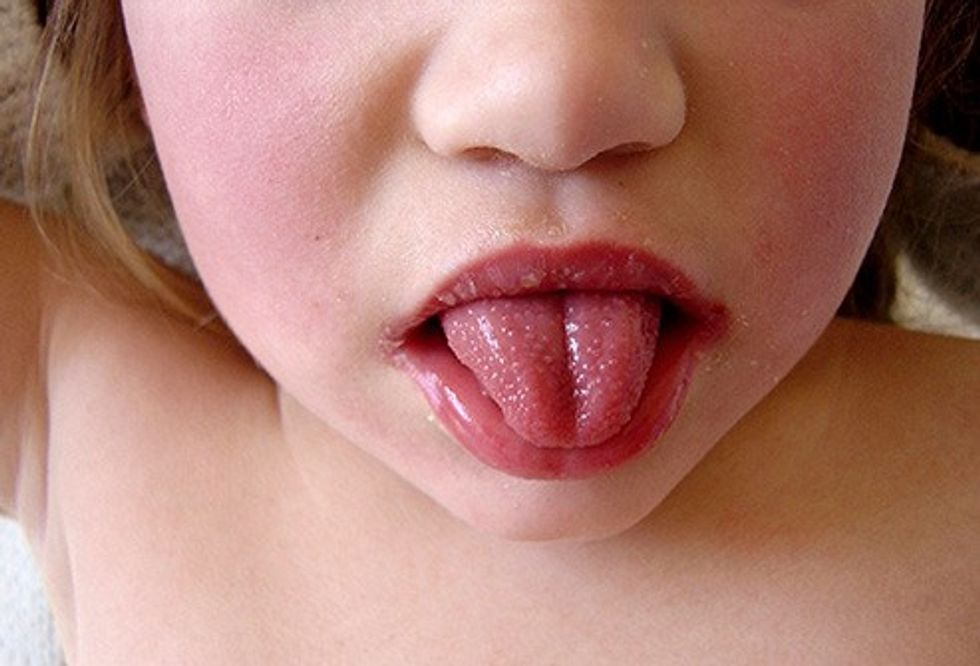 493ss medicalimages rm strawberry red tongue