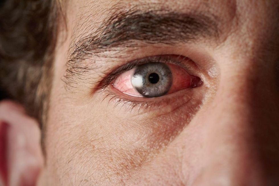 493ss thinkstock conjunctivitis close up
