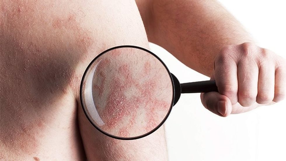 6 things that can make psoriasis better video