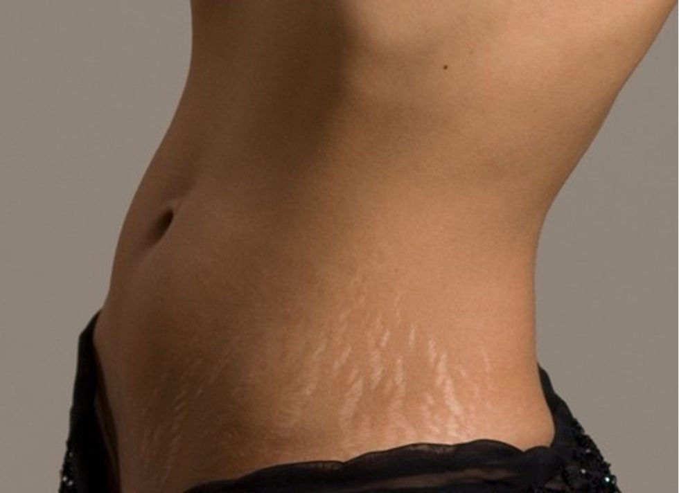 6361725292697357151837372045 The Cost of Getting Rid of Stretch Marks