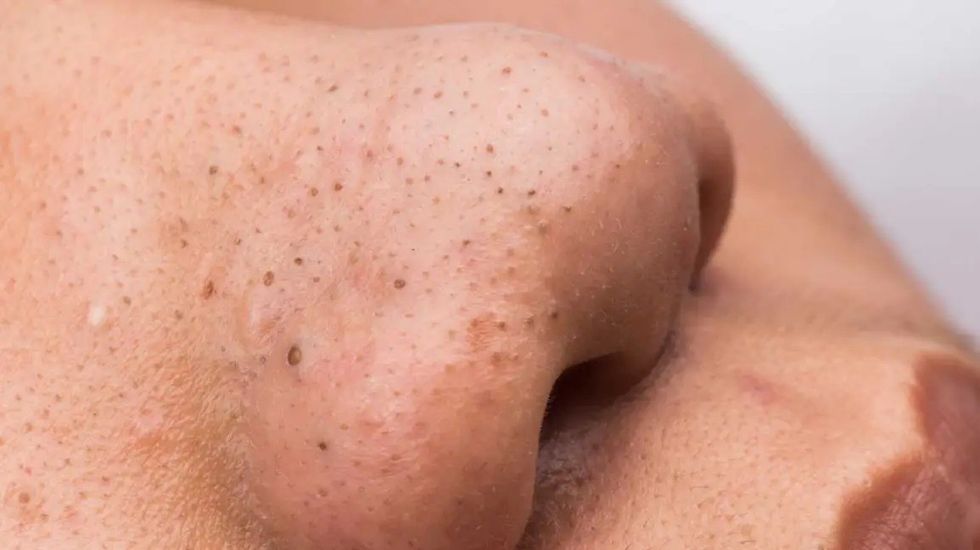 793 Blackheads body