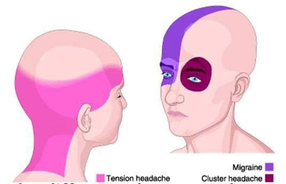 7d5e7ec0fbca1f93c8b1f9b5791b0a78 migraine diet migraine headache