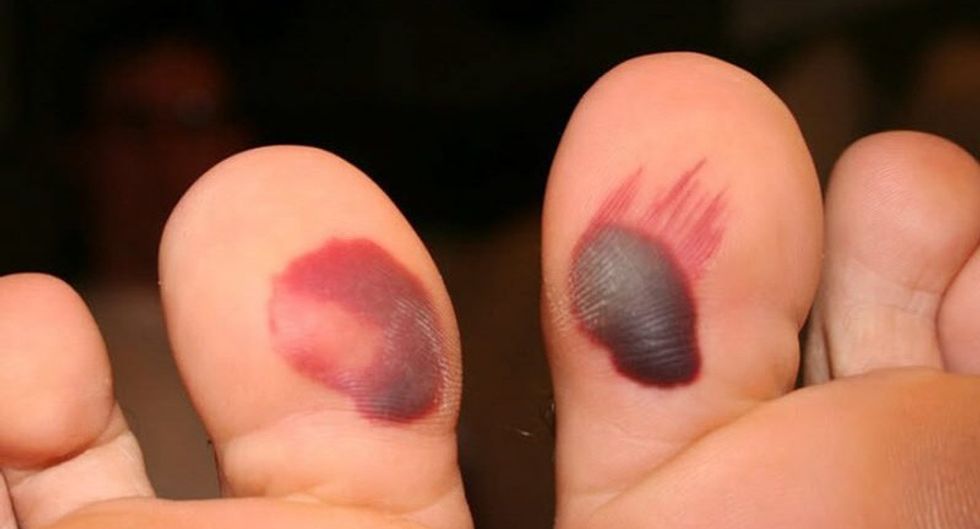 882 blood blister 1