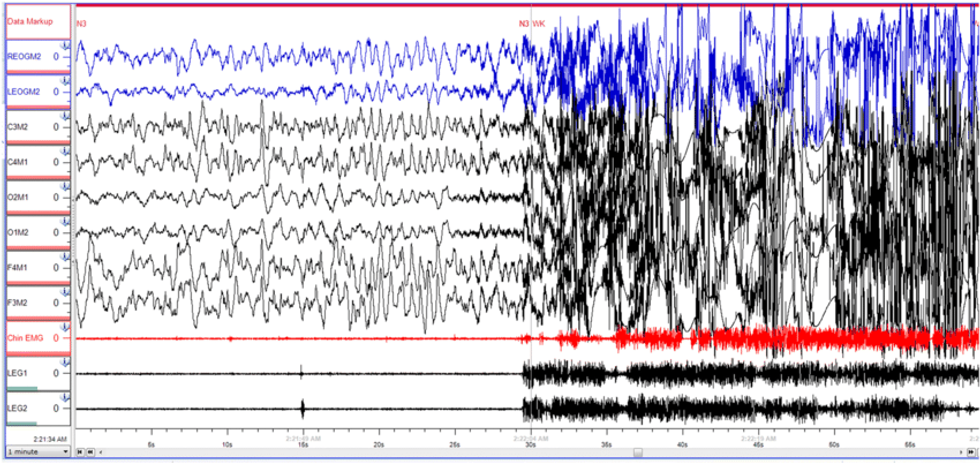 A 30 s epoch of the sleep study In the first half the patient was in stage N3