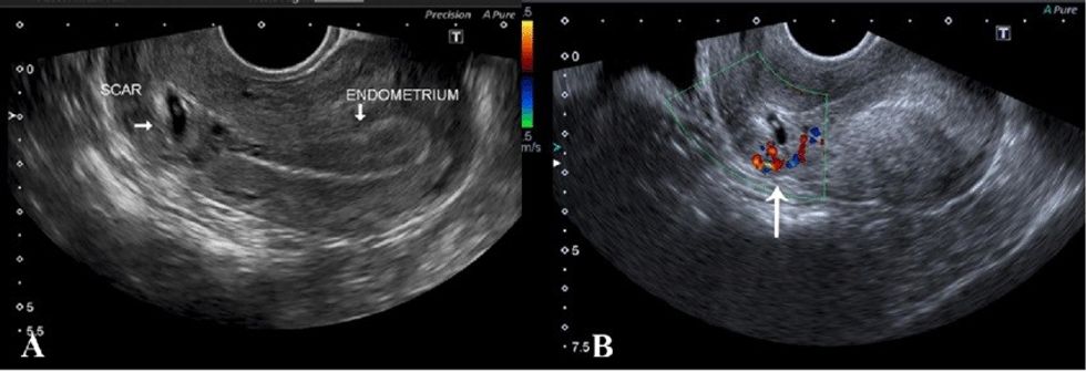 A TVS showing retroverted uterus with empty endometrial cavity and low lying