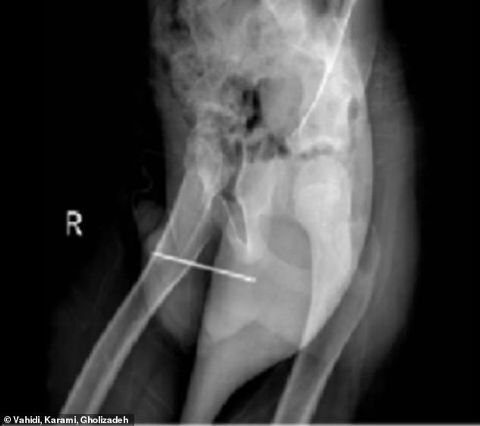 A X-Ray revealed that the 87mm sewing needle was positioned in the 10-year-old Iranian boy's urethra in such a way that trying to pull it out could have caused further damage.